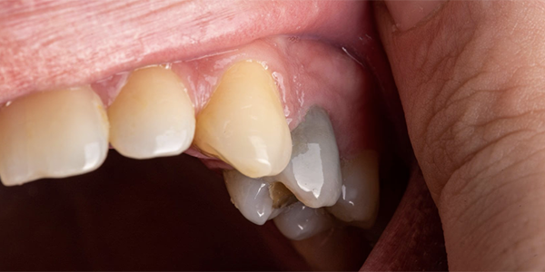 PICK UP 虫歯治療